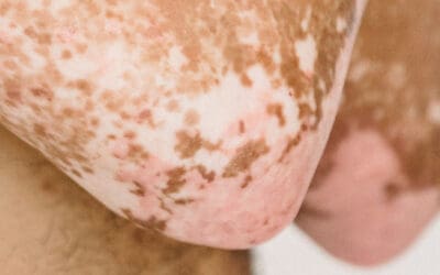 Nine Skin Cancer Sites Hidden in Plain Sight (Where to Look)