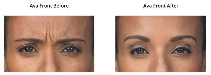 Botox and Dysport Before and After Pictures Phoenix, AZ