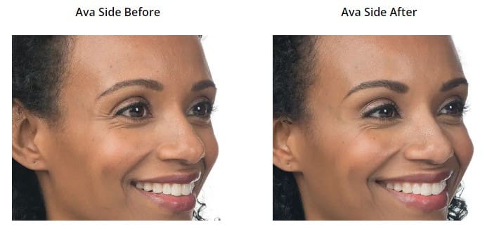 Botox and Dysport Before and After Pictures Phoenix, AZ