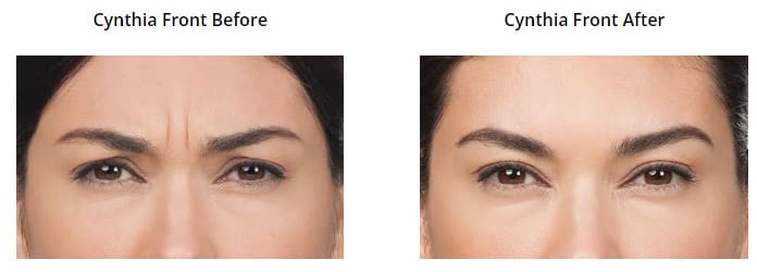 Botox and Dysport Before and After Pictures Phoenix, AZ